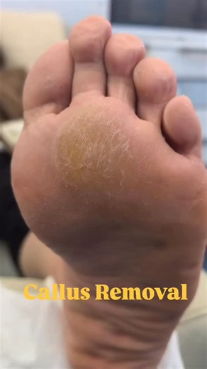 @podiatrist_sj | Dry, thick callus buildup like this can make heels rough and uncomfortable — but the transformation after removal is always so satisfying!... | Instagram