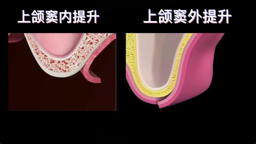 3D医学动画--种植牙上颌窦内提升术与上颌窦外提升术的区别与用途