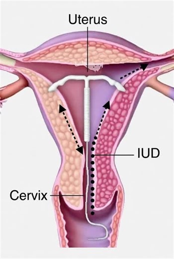 How to remove IUD #BiologyExplained #HumanReproduction #Fertilization #Fertilization #BirthControl
