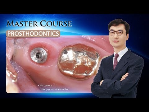 [Master Course - PROSTHODONTICS] Prosthodontic type of osstem implant system