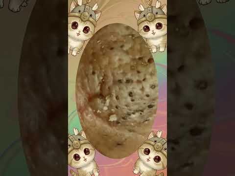 Blackheads Removal #588 | Acne Treatment and Very Satisfying Satisfying Pimple pop #blackheads
