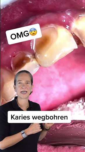 Effective Ways to Prevent and Treat Dental Cavities