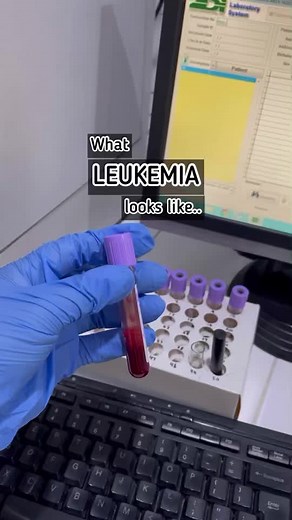 #hematology #leukemia #cancer #medtech #medtechlife #medtechtok #laboratory #health #LearnOnTikTok#Tiktokskwela #fyp #foryou #foryourpage #viral