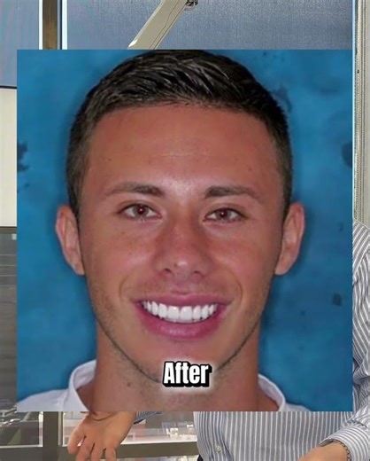Dental Veneers Before & After | Smile Transformation in Seconds