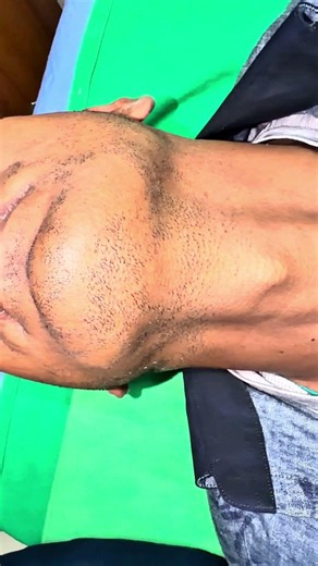 Patchy Alopecia areata