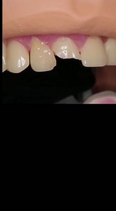 1.7K views · 48 reactions | Video of tooth filling (direct composite restoration) and dental crown procedure taken from tiktok. Click www.kperfa.weebly.com for our real cases #tiktokvideo #foreducationalpurposeonly #klinikgigiwangsamaju #klinikgigicheras #klinikgigikl #klinikgigigiselangor | Klinik Pergigian Erfa | Facebook