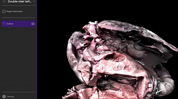 Digital walkthrough 8 - Double inlet left ventricle | Cardiac anatomy!