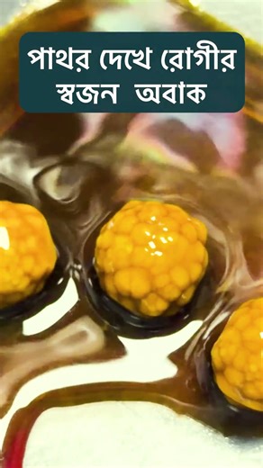 পাথর দেখে রোগীর স্বজন অবাক | Gallbladder Stones