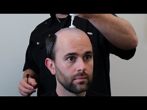 Men’s Hair System Installation