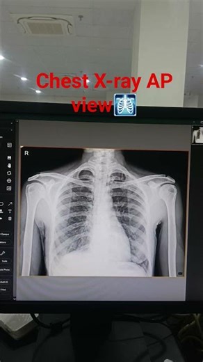 Chest X-ray AP view 🩻