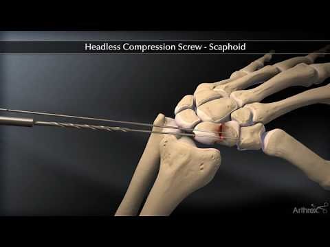 Headless Compression Screw – Scaphoid