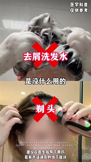 剃过光头的朋友都知道，剃头其实去不了头屑。 #头屑 #剃头 #头皮脂溢性皮炎 #医生科普 #525给皮肤放个假