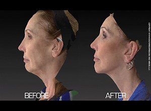 Before & After: See This Vectra Scan After a Facelift, Chin Surgery, and Laser Skin Resurfacing