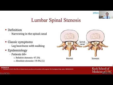 Spinal Stenosis – An Overview and Non-Surgical Approach