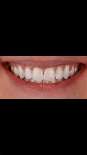 DR LIV SCHORAH on Instagram: "✖️ CROSSBITE CORRECTION ✖️ This patient had quite a severe crossbite near the front of her mouth - this is where the lower teeth sit on the outside of the upper teeth - when it should really be the other way around 🔄 Sometimes if we see this around the back teeth it doesn’t make much difference to the aesthetics or function but when it’s near the front, you can see if affects both ⬆️ You can see in the before picture the bite wasn’t comfortable and it meant her smi