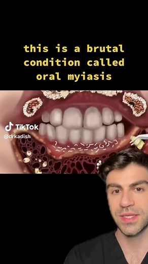 Oral Myiasis: Understanding the Brutal Condition