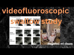 218.Videofluoroscopic Swallow Study #VFS #dysphagia #investigation