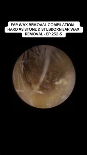 EAR WAX REMOVAL COMPILATION - HARD AS STONE & STUBBORN EAR WAX REMOVAL - EP 232-5#removal