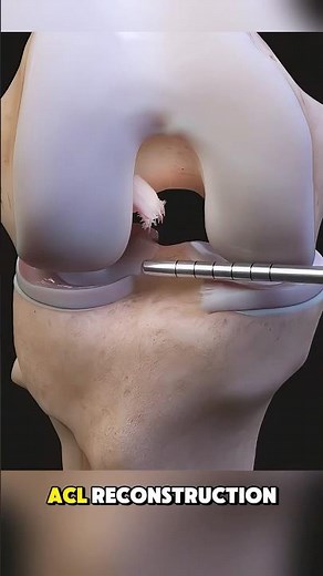 ACL Reconstruction–Symptoms You May Ignore #3danimation #symptoms #aclinjury #acltear #kneepain