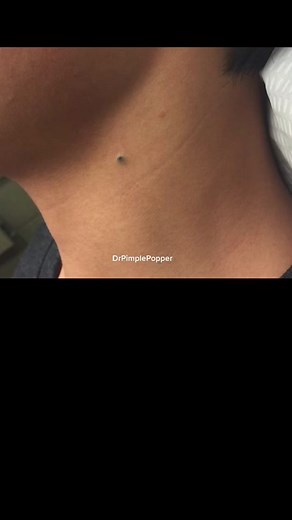 Dr. Pimple Popper Releases New Video: Overgrown Blackhead Removal