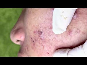 Extreme Acne & Scab Removal | Deep Pimple Popping for Severe Skin Recovery