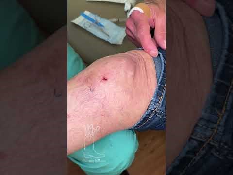 Stitch Abscess