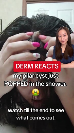 Understanding Scalp Cysts: Causes and Removal