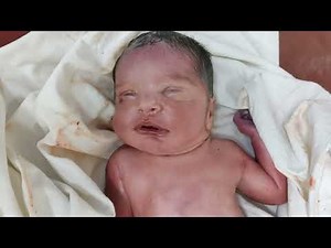 Abnormal Newborn baby born with congenital anomalies immediately after birth #special