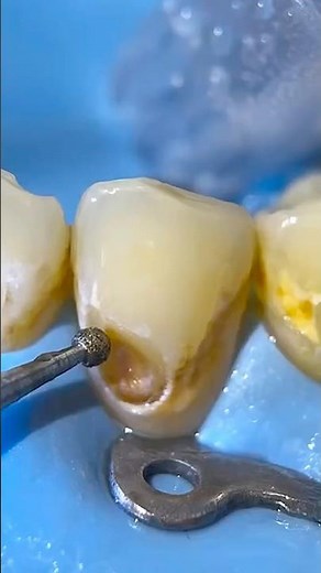 Most Satisfying Dental Restoration You’ll See Today #dentist #satisfying