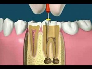 Endodontics (Root Canal Treatment)