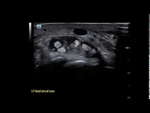 Extensor Tenosynovitis of the Wrist, Axial Fan Video JETem 2019