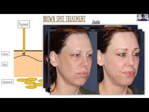 How to Eliminate Brown Spots and Red Spots With Lasers | Cosmetic Laser Dermatology Webinar
