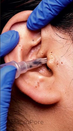 Vacuum Comedone Extraction | 4K Macro Tube ASMR #macroasmr