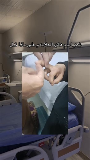 ‎دكتور رواق‎ on Instagram‎: "علامة هوفمان (Hoffman’s sign)، هي منعكس عصبي مرضي (Pathologic reflex) يُستخدم في الفحص العصبي للتحري عن فرط منعكسية (Hyperreflexia) في الأطراف العلوية، وغالبًا ما يشير إلى إصابة في (Corticospinal tract lesion) أو (UMN signs). ⸻ ⭐ كيف يتم فحص علامة هوفمان؟ 1. يمسك الطبيب إصبع المريض الأوسط أو السبابة. 2. يثنيه قليلاً ثم يتركه بشكل مفاجئ. 3. الاستجابة الإيجابية: • انثناء الإبهام • أو انثناء الإصبع الآخر (السبابة عادةً) إذا حدثت الحركة → علامة هوفمان إيجابية. ⸻ ⭐ على ما