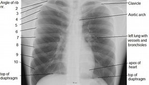 Aortic window - Alchetron, The Free Social Encyclopedia