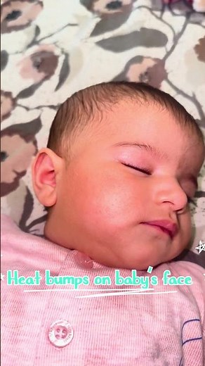 Baby Heat Rash (Heat Bumps) Treatment Using QV Cream | Gentle Skincare for Babies
