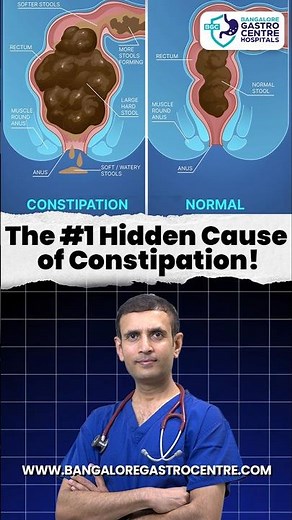 The #1 Hidden Cause of Constipation Revealed! (Most People Ignore This!