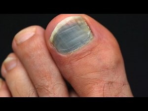 How to Treat a Black Toenail from Injury, Fungus, & More