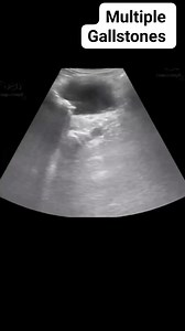 51 reactions | Multiple gallbladder stones on ultrasound #radiology #ultrasound #gallbladder | Radiology Interesting Cases | Facebook