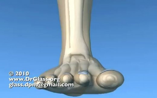 踝关节骨折 Lauge-Hansen 分型｜旋后外翻(外旋)Supination Eversion (External Rotation)