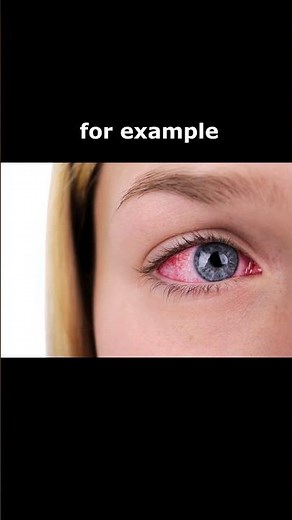 Eye Symptoms - Light Sensitivity