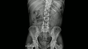 Radiografía de KUB (riñón, uréter, vejiga) que muestra la colocación del stent