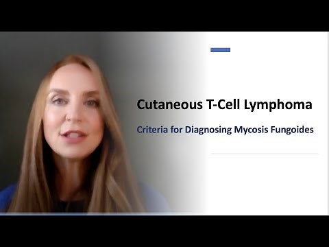 Criteria to Diagnose Mycosis Fungoides (Chapter 1)
