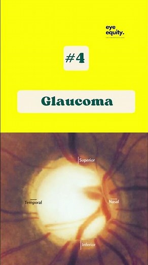 Top 5 eye diseases causing blindness | Optometry | #shorts #eye disorders