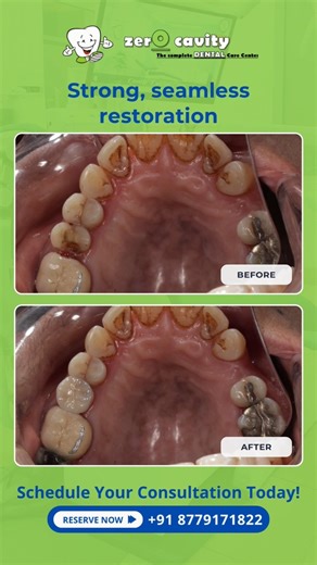 From damaged to durable ✨This crownlay restores strength, function, and a natural