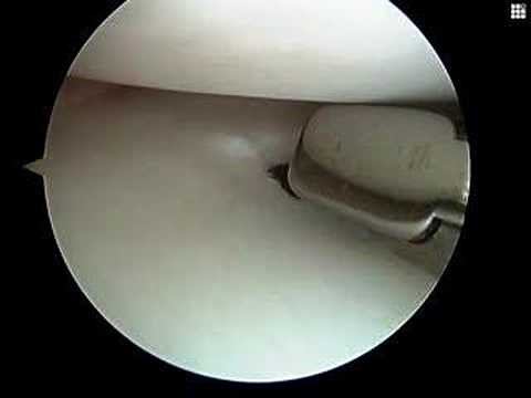 Arthroscopic Partial Meniscectomy