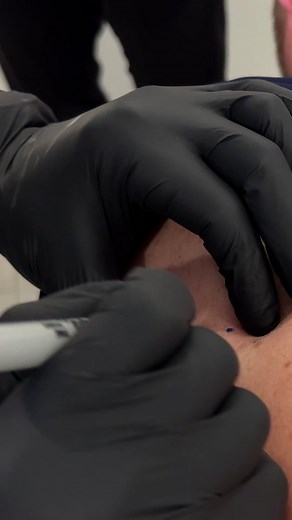 Arm cyst, part one! #pimplepopper #pimplepopping #thedoc #thedoctok #drmudgil