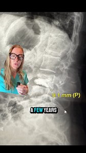 719K views · 2.4K reactions | Case study 131 - Failed Back Surgery?!...