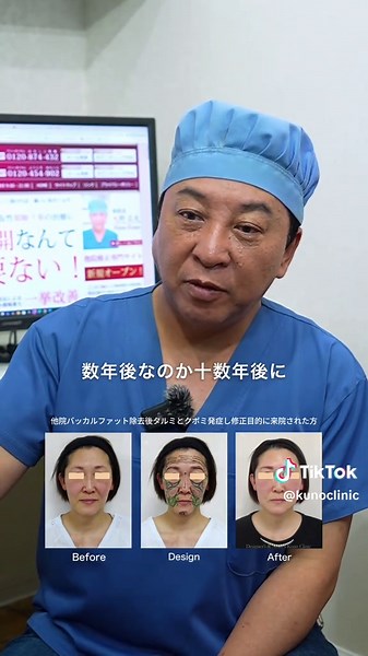 バッカルファット除去ってやばい？ 📍Clinic Nine Fields (東京都 / 麻布院) 0120-874-432 📍Kunoクリニック (大阪府 / 梅田本院) 0120-454-902 美容整形後の失敗や後遺症でお悩みの方は是非お越しください。当院長九野がカウンセリング・施術・アフターケアまで全て担当します。予約はお電話にて承ります。 #kunoクリニック #美容整形 #再生医療 #バッカルファット