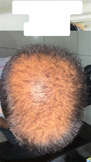 DR BASSI’s AYURVEDIC Clinic on Instagram: "Alopecia simply means hair loss. It’s not one disease, but a general term for conditions where hair falls out from the scalp or body. Types of Alopecia 1. Alopecia Areata • Autoimmune disorder → body’s immune system attacks hair follicles. • Patchy, round bald spots on scalp or beard. • Sometimes progresses to total scalp hair loss (Alopecia Totalis) or entire body hair loss (Alopecia Universalis). 2. Androgenetic Alopecia (Male/Female Pattern Baldness)